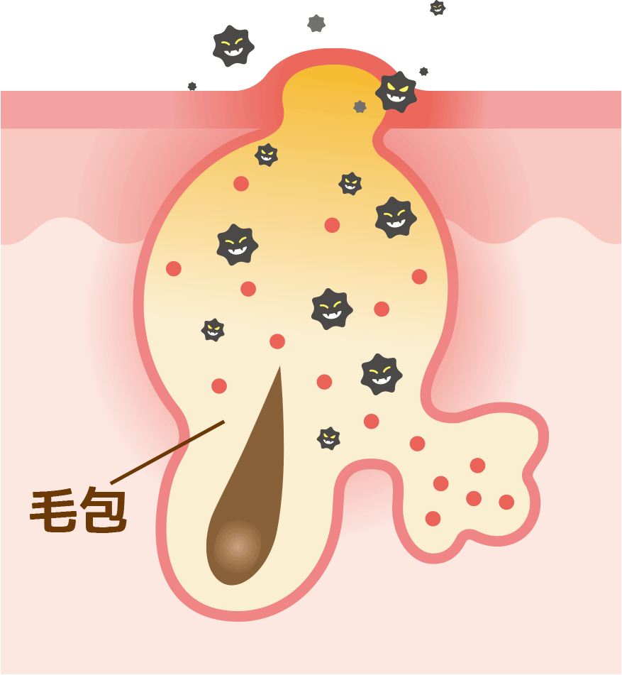 常在菌が毛穴の奥の「毛包」という皮膚組織層に侵入